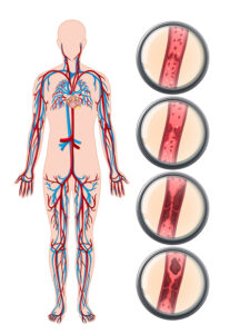 Deep vein thrombosis anatomy illustration