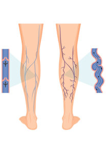 Human legs with varicose vein illustration